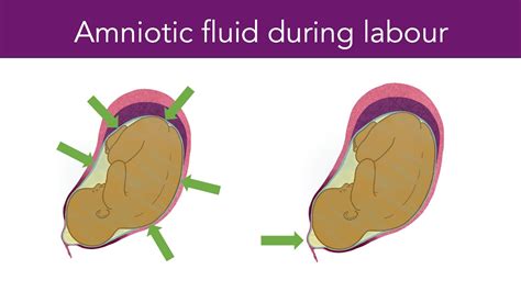 how to tell if your leaking amniotic fluid|Leaking Amniotic Fluid: How to Tell